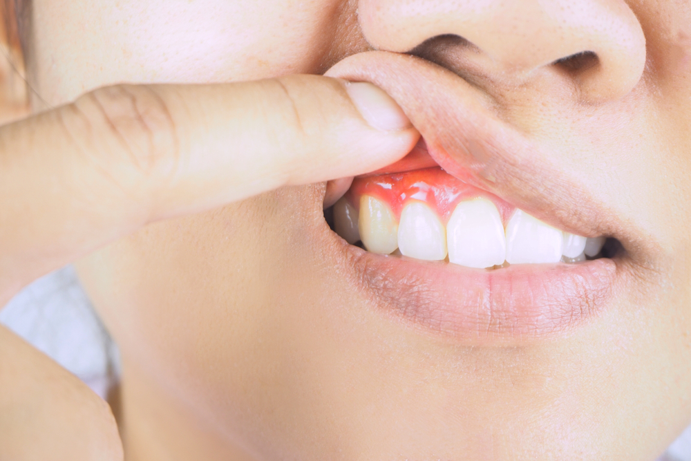 Trimble Dental | Dangers of Untreated Gum Disease: Alzheimer’s, Arthritis, Stroke